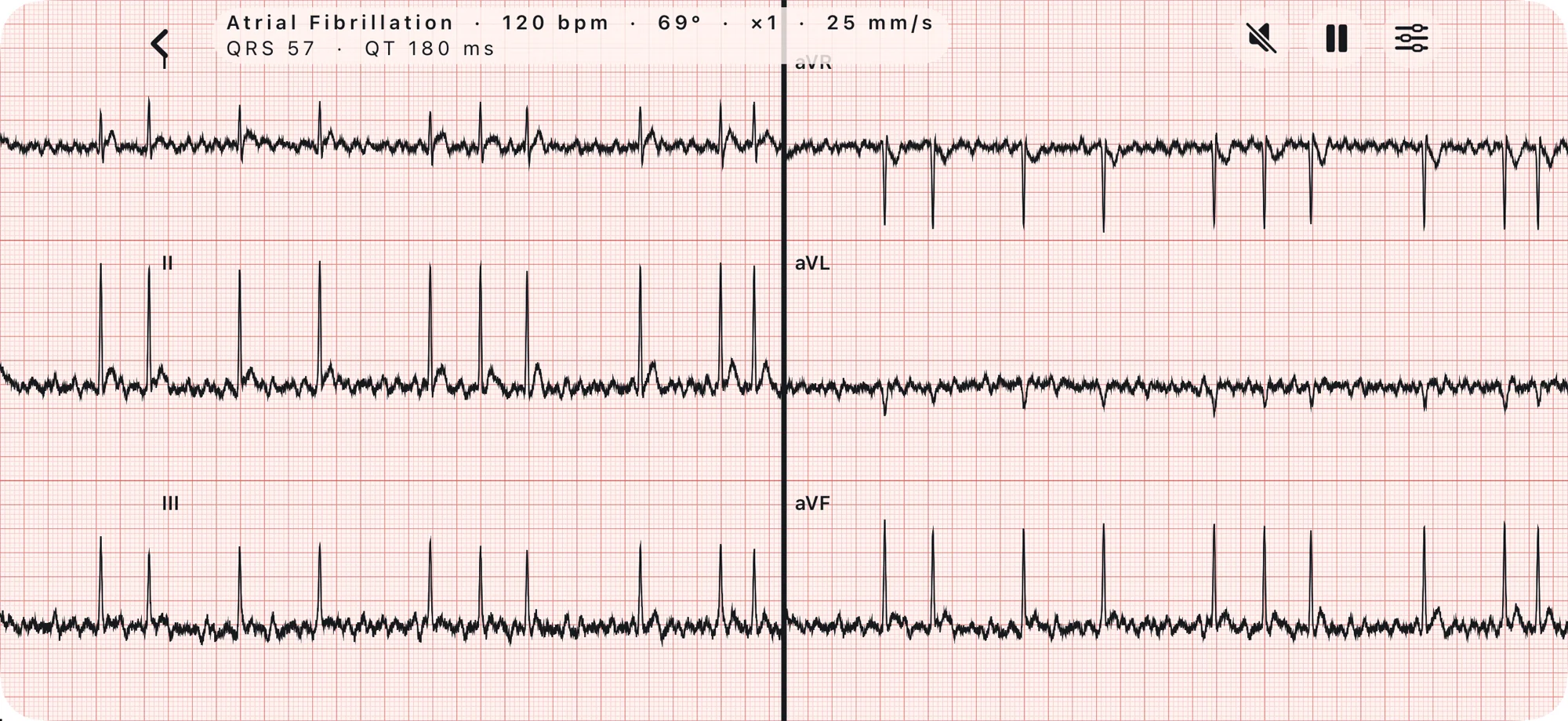 The simulator on an iPhone showing atrial fibrillation at 120 bpm on six leads, I, II, III, aVR, aVL and aVF, on ECG paper.